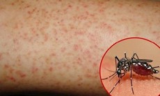 Coi chừng biến chứng nguy hiểm của sốt xuất huyết ngày mưa 