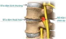 Liệu pháp tiêm hydrogel - lựa chọn mới trị đau lưng do thoái hóa đĩa đệm