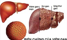 Lưu ý quan trọng khi dùng thuốc điều trị viêm gan B