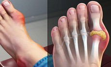 Bệnh gút (gout) là gì? Triệu chứng, chẩn đoán và cách điều trị