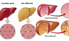 Cách ngăn ngừa gan nhiễm mỡ ở người bệnh đái tháo đường