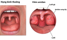 Dấu hiệu cho thấy amidan cần phải cắt bỏ