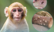 Bệnh đậu mùa khỉ: Các khuyến cáo giảm nguy cơ lây bệnh