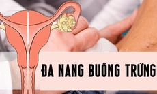 Đa nang buồng trứng và nguy biến khó lường