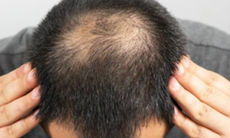 Đàn ông hói đầu có phải liên quan đến vấn đề sinh lý?