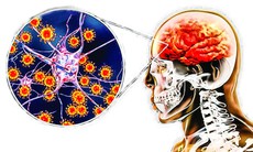 3 người tử vong vì viêm não virus, dấu hiệu nào cần lưu ý để tránh tai biến nặng?