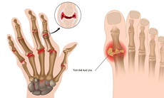 Những điều cần biết khi dùng thuốc trị bệnh gout