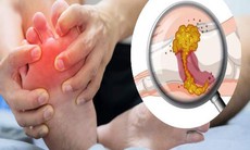 5 loại đồ uống giúp kiểm soát tình trạng tăng axit uric máu