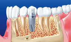 Lịch sử ra đời và phát triển của những chiếc răng giả