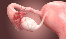 Nguyên nhân u nang buồng trứng và cách hỗ trợ bệnh từ thảo dược