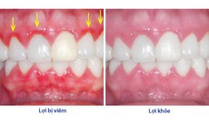 3 cách đơn giản giúp cải thiện viêm lợi tại nhà