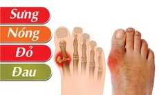 Người bệnh gout ăn gì ngày Tết để tránh cơn đau bùng phát?