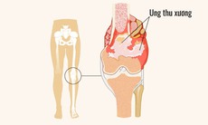 Ung thư xương: Bác sĩ cảnh báo những dấu hiệu cần lưu ý