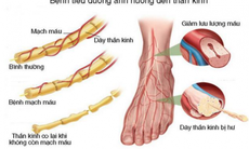 Điều trị bệnh thần kinh đái tháo đường như thế nào cho hiệu quả?