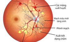 Điều trị biến chứng võng mạc do đái tháo đường