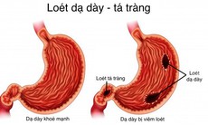 Các thuốc điều trị loét dạ dày tá tràng, dùng thế nào cho đúng?