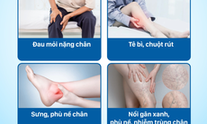 Suy giãn tĩnh mạch chân có chữa khỏi được không, ai có nguy cơ cao mắc bệnh?