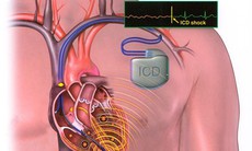 Thuốc nào giúp kiểm soát nhiễm trùng sau cấy ghép tim?