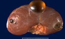 Nang thận là gì, có nguy hiểm không?