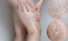 Suy giãn tĩnh mạch có thể gây ra hoại tử một số bộ phận cơ thể