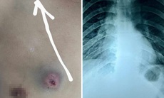 Đang làm rẫy, người đàn ông trúng 'đạn lạc' xuyên ngực