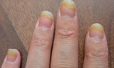 Cách điều trị nấm do sơn móng