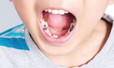 Sâu răng ở trẻ gây nhiều tác hại hơn cha mẹ nghĩ