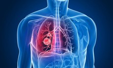 9 dấu hiệu cảnh báo ung thư phổi cần biết