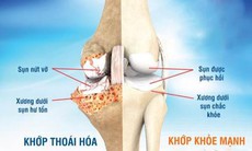 Bài thuốc làm chậm thoái hóa khớp