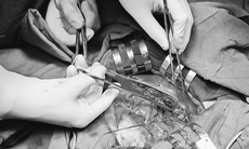 3 giờ phẫu thuật cắt thùy gan cho bệnh nhân ung thư đường mật trong gan


