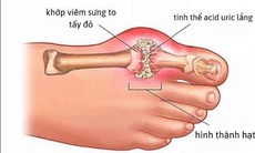 Phòng bệnh gout tái phát bằng món ăn bài thuốc đơn giản tại nhà