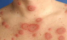 Người mắc lupus ban đỏ có phẫu thuật thẩm mỹ được không?