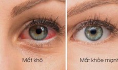 5 bài thuốc giúp giảm các triệu chứng khô mắt
