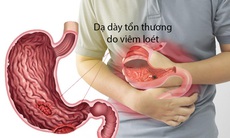 Căng thẳng dễ gây đau bụng, đau dạ dày