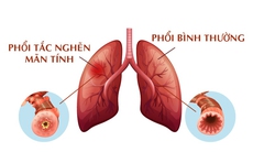 Bệnh phổi tắc nghẽn mạn tính: Nguyên nhân gây tử vong xếp hàng thứ 3