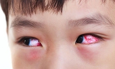 Bé trai mù một bên mắt vì nhỏ sữa mẹ chữa viêm mắt