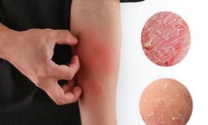 4 bài thuốc bổ huyết phòng ngừa da khô mùa đông
