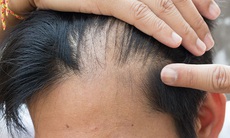 Rụng tóc hói đầu ở nam giới, nguyên nhân và cách khắc phục
