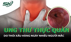 Phát hiện ung thư thực quản do thói quen thường ngày nhiều người mắc
