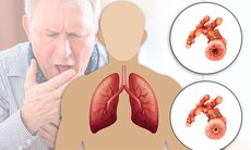 Bệnh phổi tắc nghẽn mạn tính (COPD): Nóng lạnh đan xen dễ bùng phát các đợt cấp của COPD