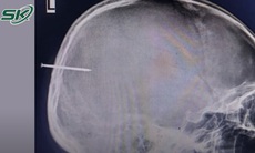 Nam thanh niên chảy máu não do bị đinh sắt dài 5cm đâm vào đầu