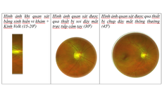 Công nghệ chụp đáy mắt giúp chẩn đoán bệnh võng mạc