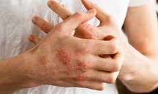 Bệnh về da hay gặp vào mùa đông và cách hạn chế