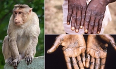 Bệnh đậu mùa khỉ có chữa khỏi được hoàn toàn?