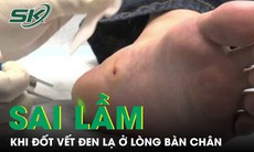 Sai lầm khi đốt vết đen lạ ở lòng bàn chân