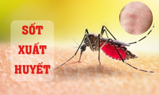 Sốt xuất huyết, sốt virus và sốt phát ban: Phân biệt như thế nào?