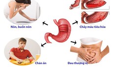 Những dấu hiệu điển hình của đau dạ dày