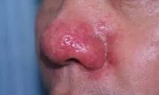 3 bài thuốc Đông y chữa bệnh mũi đỏ