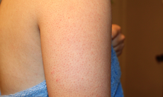 Trị dày sừng nang lông tại nhà khi thời tiết lạnh