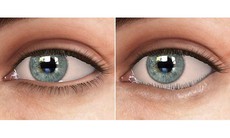 Bác sĩ chuyên khoa chỉ cách xử lý lông mi quặm